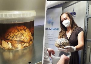 V pražské Fakultní Thomayerově nemocnici otevřeli banku mozkových tkání. Bude uchovávat vzorky mozků pacientů s neurodegenerativními nemocemi, jako je Parkinsonova choroba nebo Alzheimerova choroba a má také za cíl pomoci s výzkumem nových léků.