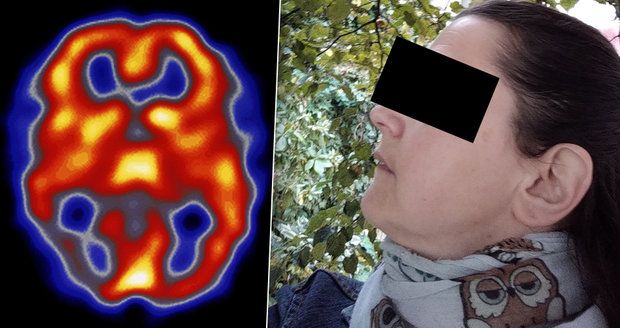 Gábině (41) ničila migréna život: Injekce do hlavy, psychické problémy i stres