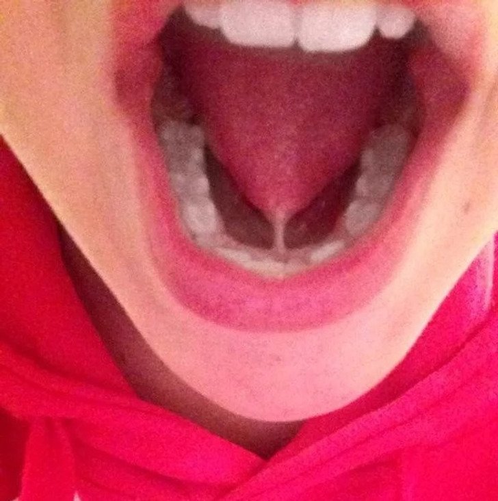 Špička jazyka přirostlá k ústní dutině