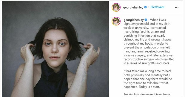 Georgie Henley ukázala jizvy na ruce.