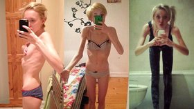 Šokující přiznání: Blogy anorektiček mě málem zabily, vážila jsem 35 kilo