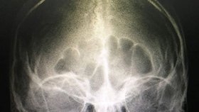 Děsivý rentgen Leandrovy hlavy se zakousnutým granátem