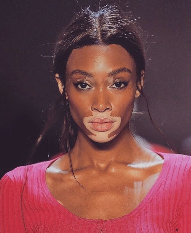 Winnie Harlow