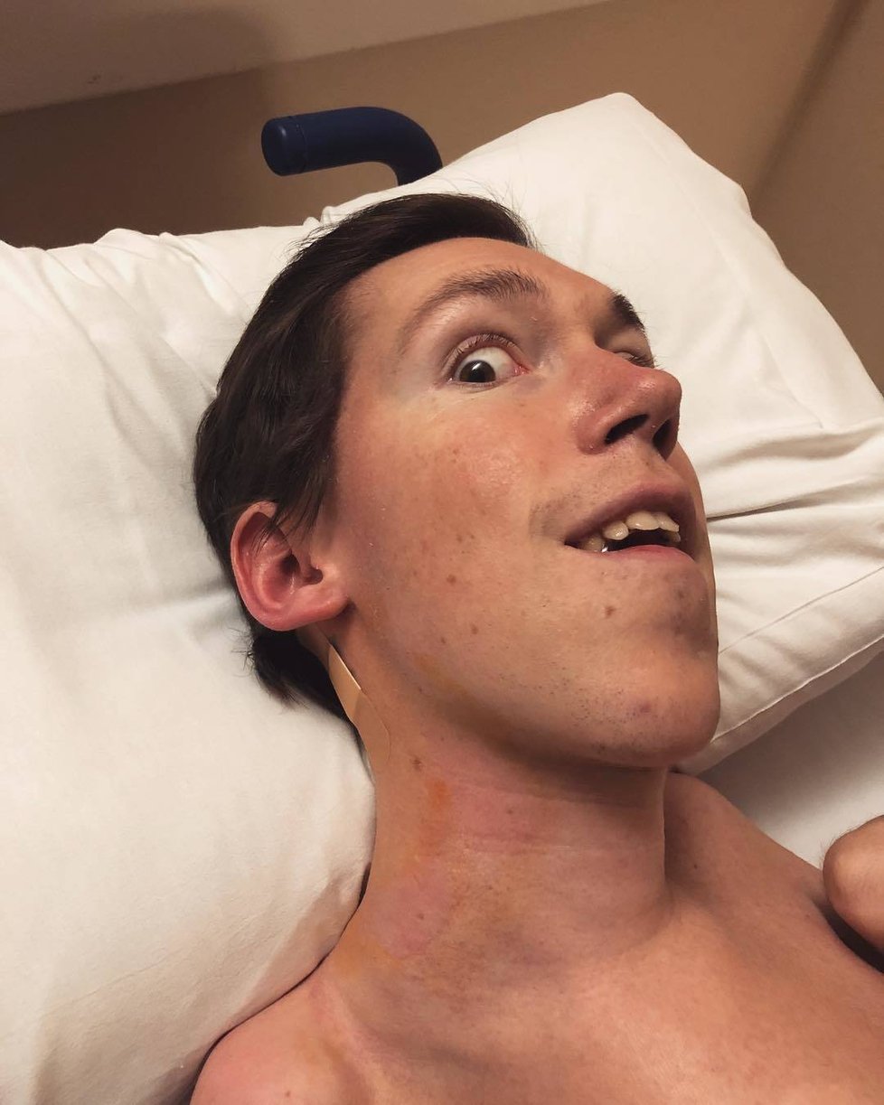 Shane Burcaw trpí spinální svalovou atrofií (SMA).