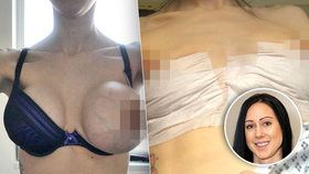 Matce praskl prsní implantát: Jedno ňadro měla jako meloun!
