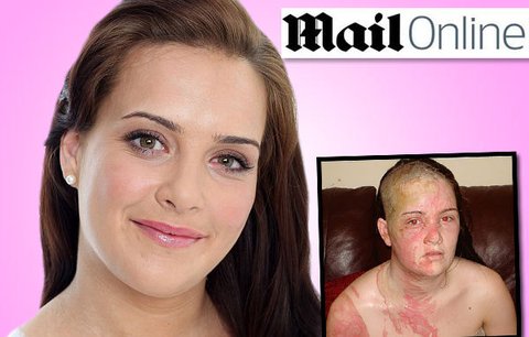 Hannah (21): Servírka jí vychrstla vroucí olej do tváře