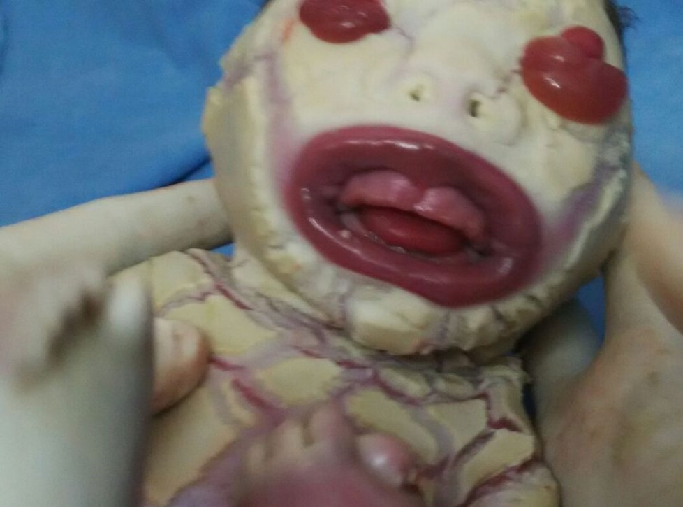 Takhle vypadá čerstvě narozené miminko se vzácnou kožní chorobou Harlequin ichthyosis (Harlekýnova ichtyóza).