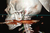 Muž prostřelil manželce harpunou pusu: Být to o centimetr vedle, je mrtvá, řekl doktor