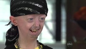 Dívenka trpící progerií zemřela v 17 letech.