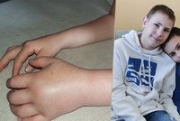 Dominik (11) a Leoš (14) mají vzácnou nemoc: Trápí je bolestivé otoky, vyvolat je může počasí i stres