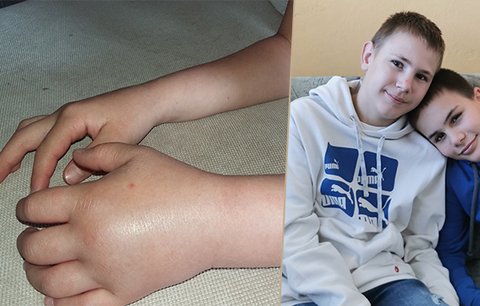 Dominik (11) a Leoš (14) mají vzácnou nemoc: Trápí je bolestivé otoky, vyvolat je může počasí i stres