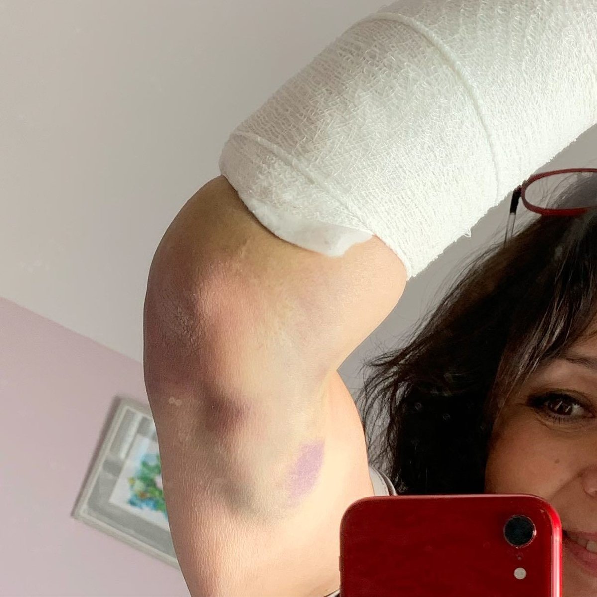 Zpěvačka Heidi Janků si na začátku roku 2021 zlomila ruku a vymkla ji v zápěstí.