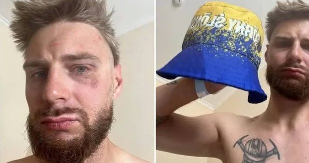 Poláka Jakuba Heisiga napadli v Ostravě kvůli modrožlutému kloboučku. Nadávali mu do banderovců. On jel na kole charitatativní jízdu pro svou přítelkyni v barvách Horního Slezska. Poláka Jakuba Heisiga napadli v Ostravě kvůli modrožlutému kloboučku. Nadávali mu do banderovců. On jel na kole charitatativní jízdu pro svou přítelkyni v barvách Horního Slezska.
