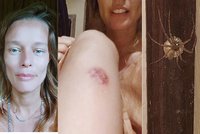 Houdová na kapačkách po kousnutí pavoukem: Bylo to požehnání! Oživilo to traumata