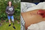 Při chůzi po chodníku jí prasklo koleno: Amputace jí zachránila život!