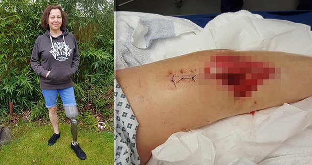 Při překračování obrubníku jí prasklo koleno: Po mnoha operacích jí museli nohu amputovat!