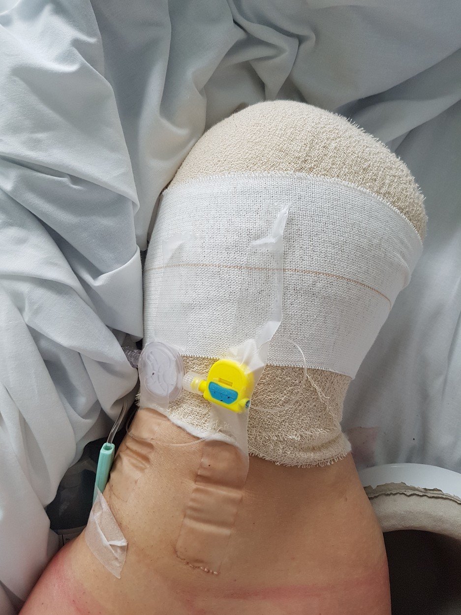 Při chůzi po chodníku jí prasklo koleno: Amputace jí zachránila život!