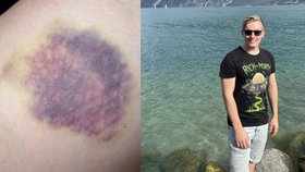 Daniel (23) žije s vzácnou nemocí krve, přesto chce zdolat Mont Blanc!