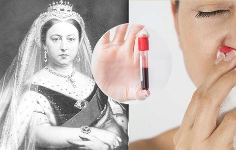 Nemoc, při níž hrozí vykrvácení: Jsou hemofilici potomky královny Viktorie? Odborníci řekli, jak to je!