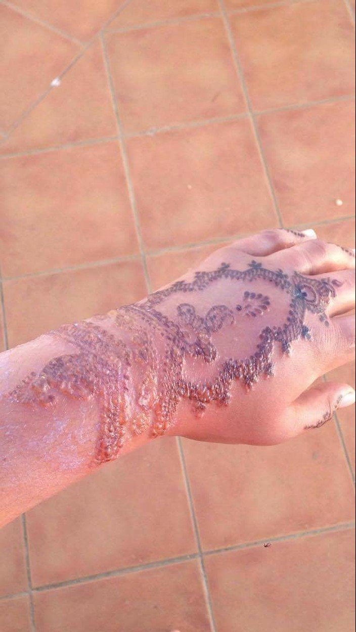 I takto může dopadnout malování hennou na kůži.