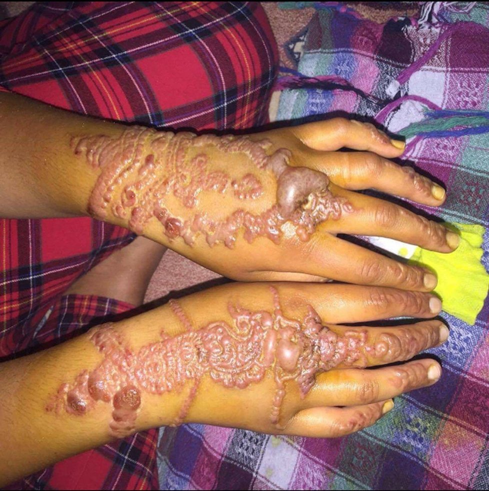 Britka Sophie Akisová (22) měla alergickou reakci na hennu.