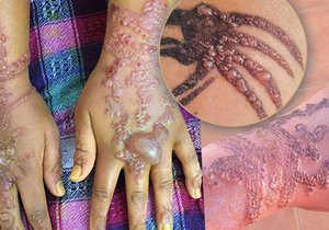 Bolestivé otoky, podrážděná kůže, jizvy - i tak může dopadnout tetování hennou