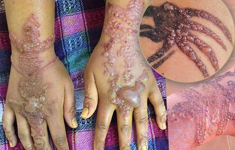 Dívce (9) na dovolené po tetování hennou vyskákaly puchýře. Lékař vysvětluje, co způsobuje bolestivé „spáleniny“