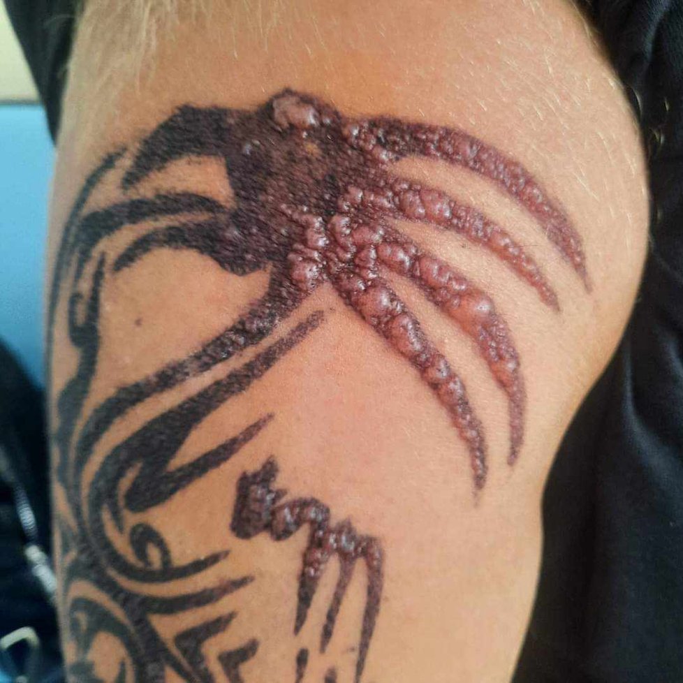 Alergická reakce na tetování hennou