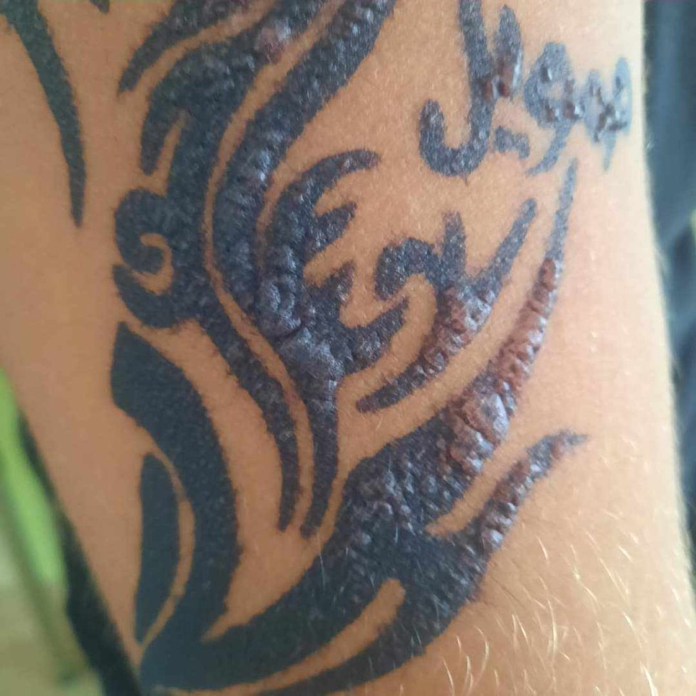 Alergická reakce na tetování hennou