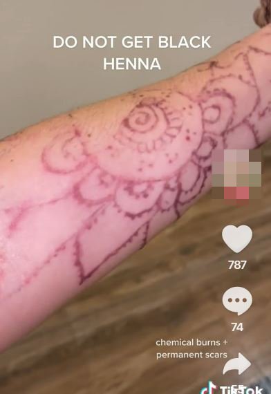 Takto může dopadnout tetování hennou