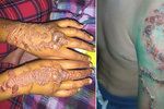 Tetování hennou může skončit zjizvením těla a velkými bolestmi.