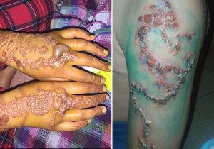 Tetování hennou může skončit zjizvením těla a velkými bolestmi.
