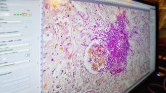 Vědci zjistili, že zřejmě vyléčili dalšího pacienta s AIDS Vědci zjistili, že zřejmě vyléčili dalšího pacienta s AIDS