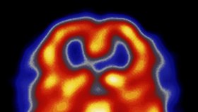 Mozek při záchvatu migrény