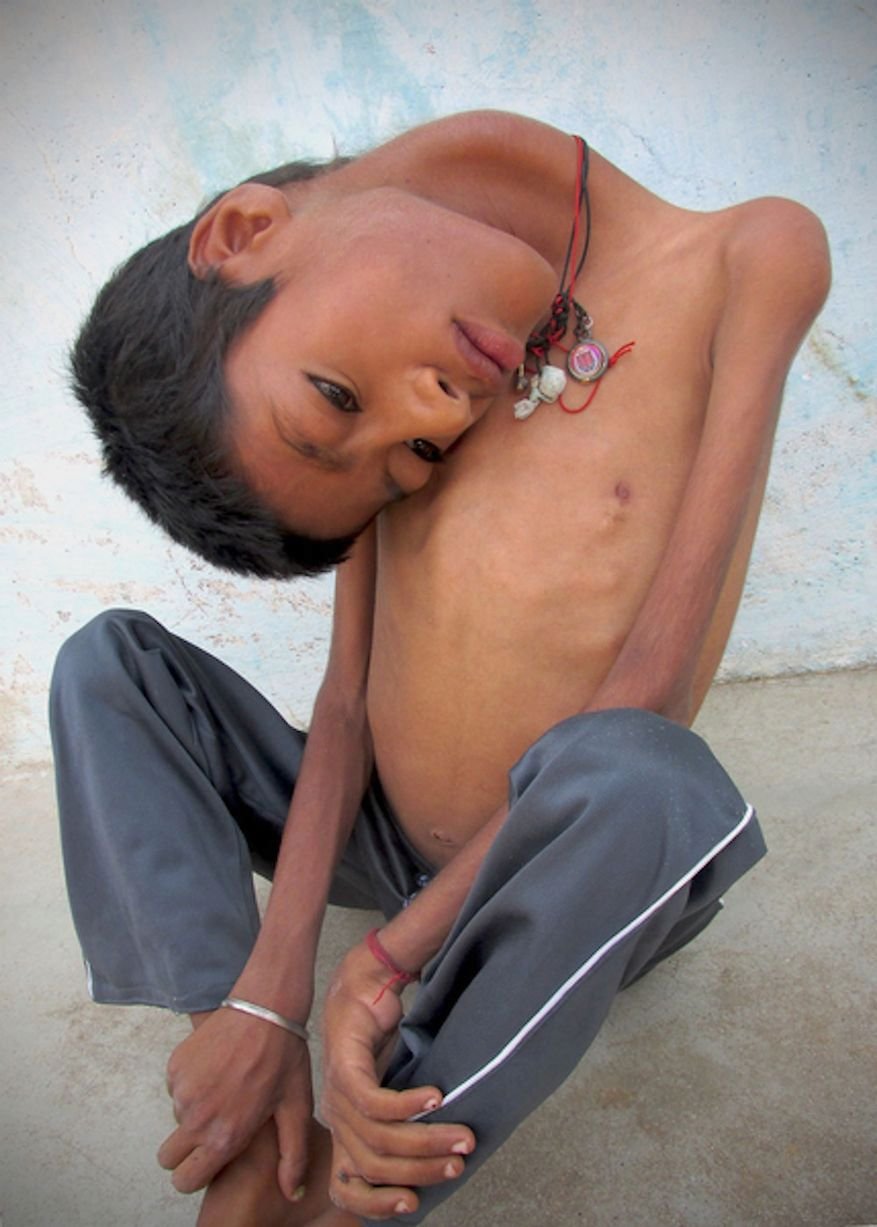 Chlapec Mahendra z Indie má kvůli nemoci ochablé svaly na krku.
