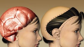 Obrázek č.1 - Stroj ženě serval kůži i s vlasy a část ucha.  Obrzázek č.2 - Detail jizvy po plastické operaci