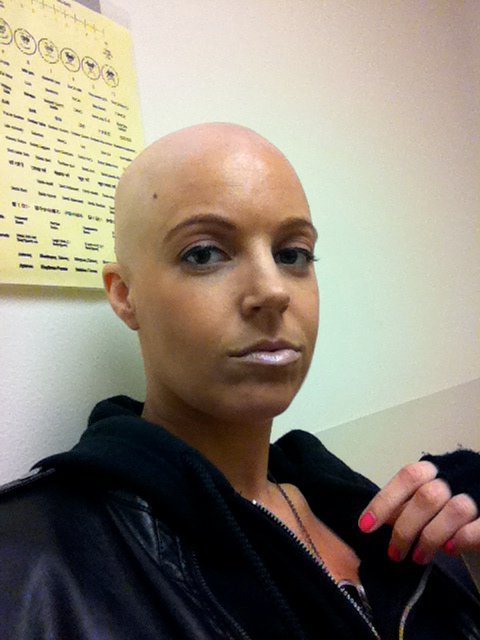 Po chemoterapi Hollie lékaři odebrali levé prso. 