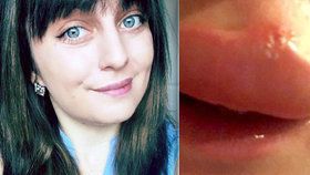 Holly Clegg trpí vzácnou nemocí, kvůli které se jí dělají pod kůží bolestivé abscesy.