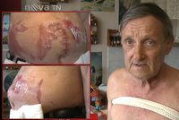 Běžná operace kýly se změnila v horor: Pan Hošek (65) začal hořet na operačním stole!
