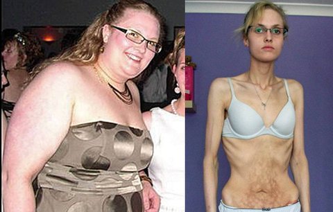 Zhubla 70 kilo, kvůli dietám bojovala o život