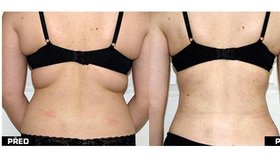 Získejte perfektní postavu díky liposculpturingu!