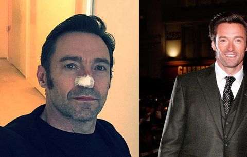 Hugh Jackman kvůli rakovině na další operaci. Nebuďte blázni jako já, vzkazuje