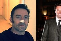 Hugh Jackman kvůli rakovině na další operaci. Nebuďte blázni jako já, vzkazuje