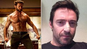 Hollywoodská star Jackman: Mám rakovinu kůže! A poslal fotku jako varování