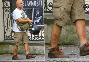 Herec Hynek Čermák upadl a sedřel si ošklivě holeně.
