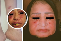 Žena utrpěla děsivou reakci na ibuprofen: Otekl jí obličej i oči!