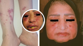 Žena (45) z Iráku utrpěla děsivou reakci na ibuprofen.