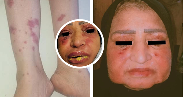 Žena utrpěla děsivou reakci na ibuprofen: Otekl jí obličej i oči!