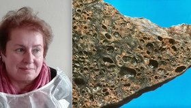 Jaroslava trpí idiopatickou plicní fibrózou, pojišťovna jí nechce propatit léčbu