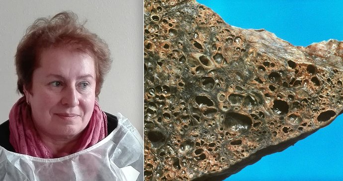 Jaroslava trpí idiopatickou plicní fibrózou, pojišťovna jí nechce propatit léčbu